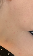 Has anyone had the rash