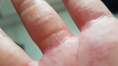 Rash only affecting one hand