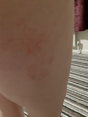 Rash on DD leg and thigh (photos enclosed)