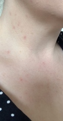 Has anyone had the rash