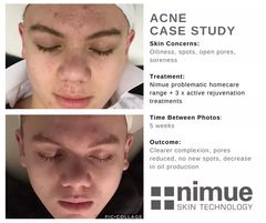 Best sensitive face wash for acne