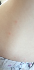 Can anyone help me identify if this is chicken pox?