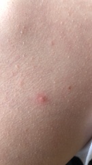 Has anyone had the rash
