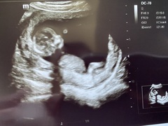10 week scans