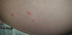 Can anyone help me identify if this is chicken pox?