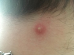 *KLAXON!* green zit!