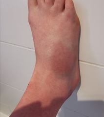 Just a sprain right?