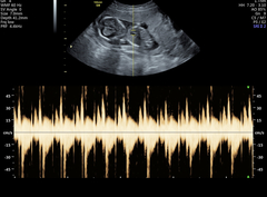 Low lying placenta
