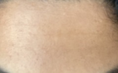 Awful skin (pigmentation and pick marks on cheeks for years) PICS included