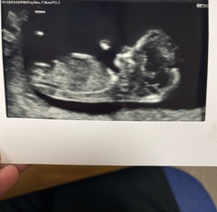 10 week scans