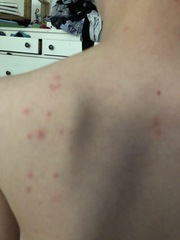 Has anyone had the rash