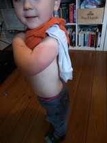 Any medical staff or experienced parents? DS massive mottled bruise after pre-school jabs, bit worried