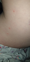 Can anyone help me identify if this is chicken pox?