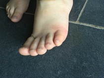 puncture wound? advice needed (photos)