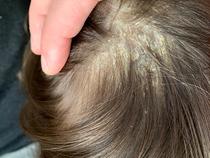 What's going on with son's scalp? (Pictures attached - don't click if squeamish!)