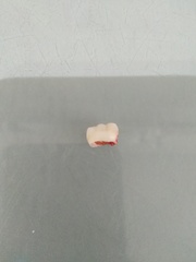 Ds just lost an adult tooth *help*