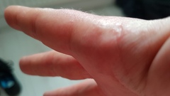 Rash only affecting one hand