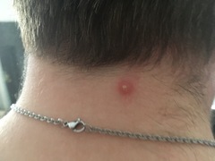 *KLAXON!* green zit!