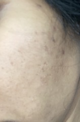 Awful skin (pigmentation and pick marks on cheeks for years) PICS included