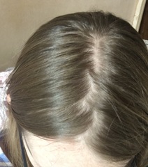 Hair loss / extremely thin