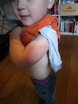 Any medical staff or experienced parents? DS massive mottled bruise after pre-school jabs, bit worried