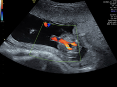 Low lying placenta