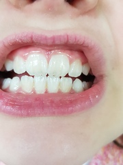 To leave dd's teeth