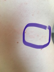 Does anyone get skin marks like these?