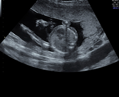 Low lying placenta