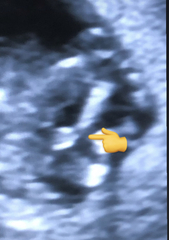 13 week potty shot ... girl or boy?