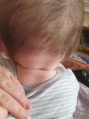Skin fold at 10 month old neck *pics attached*