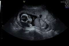 Low lying placenta