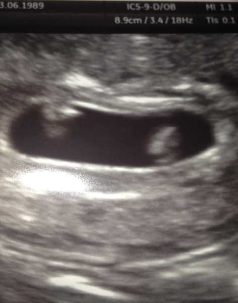 Catching up - ttc after miscarriage part 2