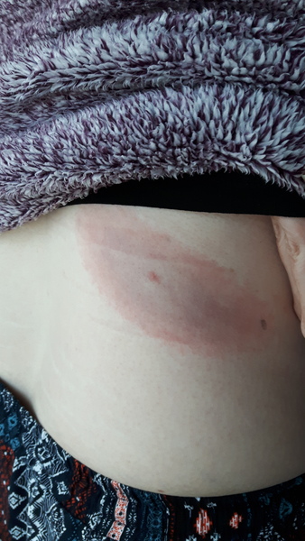 Is this bullseye rash lyme disease?