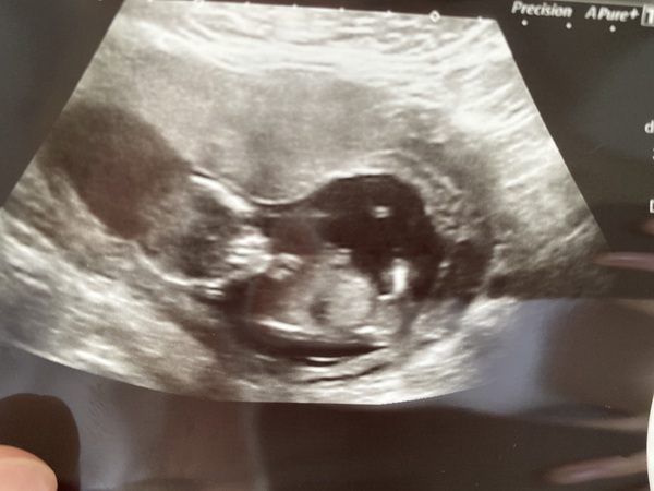 12 week scan time ladies 👣 Pregnancies due Late November/December