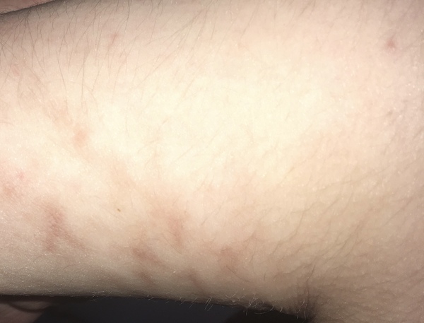 To phone 111 with weird new rash on adult?