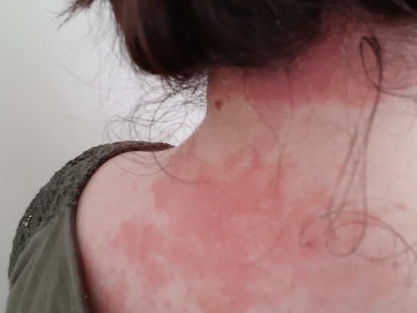 Itchy rash driving me crazy, can anyone identify it? Pic
