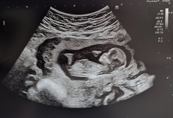 12 week scan time ladies 👣 Pregnancies due Late November/December