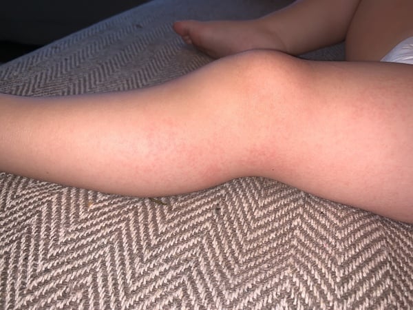 Please help! Dd covered in rash!