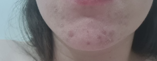 Lymecycline - acne experiences