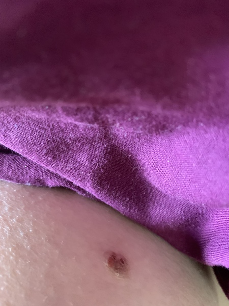 Should I be worried about this mole? Pic attached