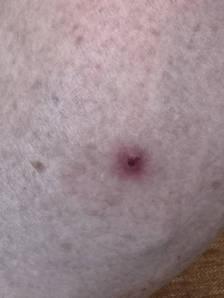 Tick bite?