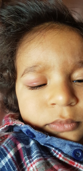 Eye infection in toddler