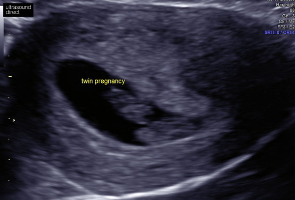 Expecting twins in 2020?