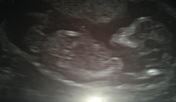 12 week scan time ladies 👣 Pregnancies due Late November/December