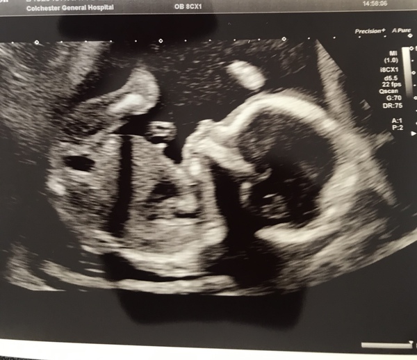20 week scan