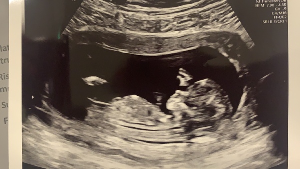 12 week scan time ladies 👣 Pregnancies due Late November/December