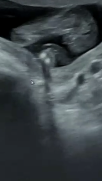 Told wrong gender at ultrasound??