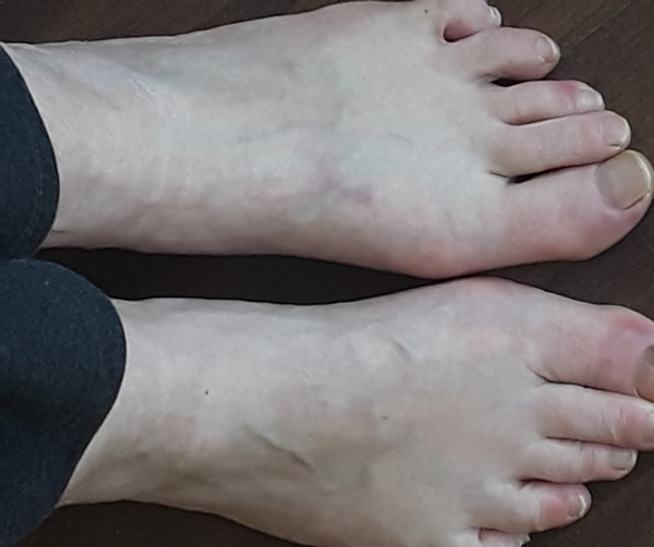 Has anyone else got ‘COVID toes’