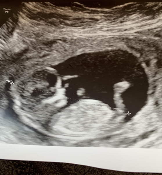 13 Week Gender scan guess 🤰🏻👶🏻